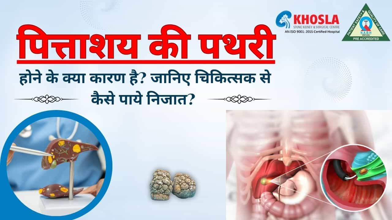 पित्ताशय की पथरी होने के क्या कारण है? जानिए चिकित्सक से कैसे पाये निजात?