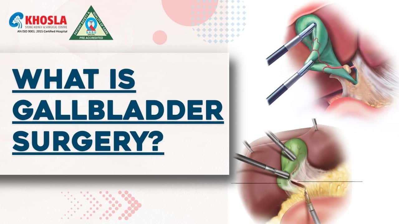 Procedure of the gallbladder surgery and precautionary measures after surgery | Khosla Stone Kidney & Surgical Centre