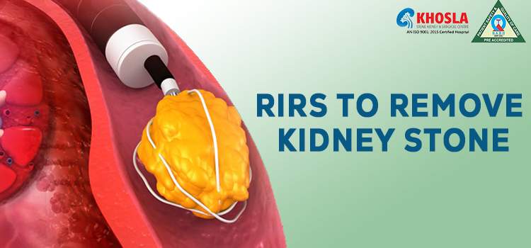 Is RIRS Surgery An Ideal Option To Eliminate Your Kidney Stones?