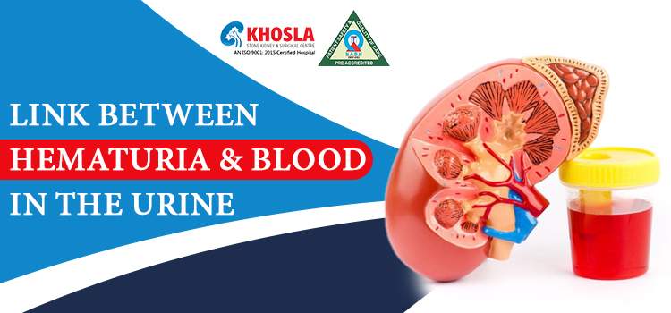 Is Hematuria or Blood in the Urine, a Serious Health Issue?