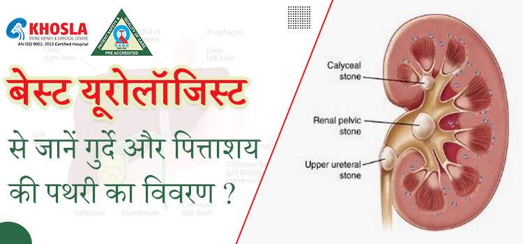 गुर्दे और पित्ताशय की पथरी के अंतर को कैसे जानें ?